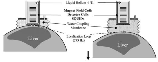 Figure 1. Difference method for the measurement of the liver iron concentration by biomagnetic liver susceptometry: From the start position (left), the patient is lowered in an inhomogeneous magnetic field of 20–30 milliTesla by about 5 to 10 cm (right) to a field of 1 milliTesla. During this vertical scan, the water coupling bag follows the patient and the change of the magnetic flux as a function of the distance is registered in the detector coils and transformed by the SQUID electronics.
