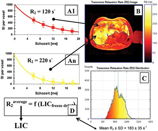 Figure 2. Iron distribution in a 5 mm liver slice of a patient with HbE/β-thalassemia (29 y, HCV+) measured in a 1.5 T imager (Philips Intera Gyroscan®, CHRCO Oakland, USA) with an average LIC of 18.6 mg/gdry wgt (Ferriscan®). The transverse relaxation R2 per volume element (voxel) and therefore the iron distribution ranges from 6.0 mg/gdry wgt (red: R2 ≥ 92 s−1) to 30.5 mg/gdry wgt (yellow: R2 ≤ 280 s−1).