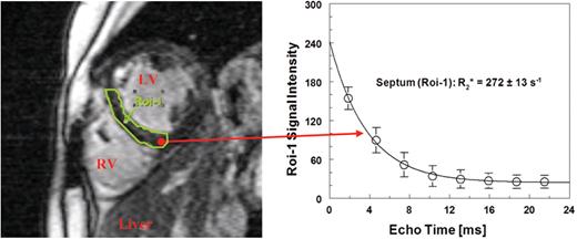 Figure 3. Mid-papillary short axis slice at an echo time of 7.5 ms in a patient with b-thalassemia major (30 y) for assessing the signal intensities in the septum (Roi-1) (single-breathhold multi-echo method TE = 1.9 - 22 ms: 1.5 T Siemens Magnetom Symphony®, UKE Hamburg). The subsequent exponential fit yields a short relaxation time T2* = 1000/R2* = 3.7 ms, while the liver iron concentration in this patient is relatively low LIC (BLS) = 1090 ± 114 μg/gliver.