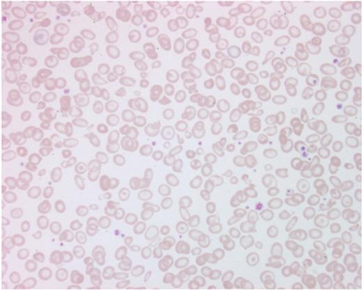 Figure 3. Showing red cell morphology in Hb H disease with hypochromic red cells and numerous anisopoikilocytosis.