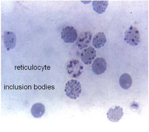 Figure 4. Red cell inclusion body was induced after the incubation of red cell with brilliant cresyl blue.