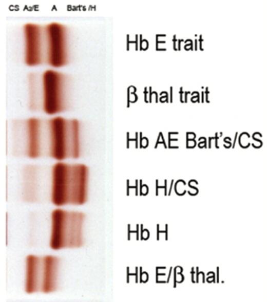 Figure 5. Starch gel electrophoresis in the alkaline pH 8.6 showing Hb H as a fast moving band.