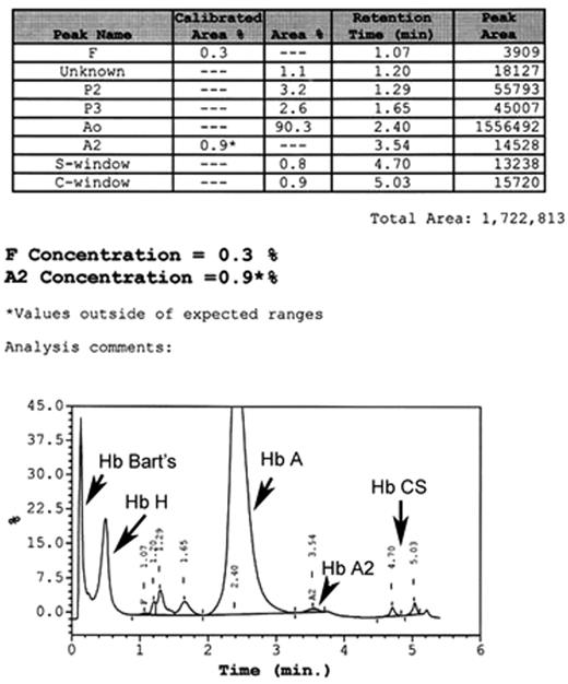 Figure 6. Hemoglobin analysis of Hb H-Hb CS patient showing Hb Bart’s, Hb H, Hb A, Hb A2, and Hb CS by automated HPLC system (Bio Rad Variant Hemoglobin Analyzer, Hercules, CA).