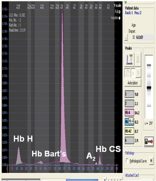 Figure 7. Hemoglobin analysis in Hb H-Hb CS using capillary zone electrophoresis (Sebia, Inc, Norcross, GA).