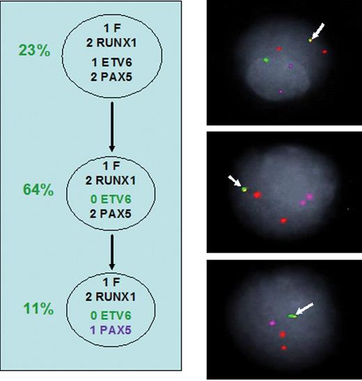 Figure 6. Sub-clonal genetic structure in a patient with ETV6-RUNX1–positive acute lymphoblastic leukemia (ALL).
Arrow, ETV6-RUNX1 fusion (F). RUNX1, orange. ETV6, green. PAX5, magenta.
Circles (percentage) = subclones with distinctive genotypes (gene copy number variations) and their relative proportions in the total ALL cell population.
