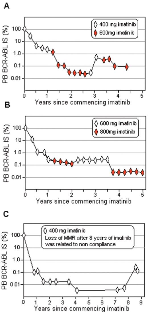 Figure 1. Rise and fall of BCR-ABL levels related to imatinib dosage.
Marked variation in BCR-ABL levels was observed in patient A when the dosage was changed from 400 to 600 mg, whereas the changes were more subtle for patient B when the dosage was changed from 600 to 800 mg imatinib. Patient C had a confirmed loss of MMR more than 8 years after commencing 400 mg imatinib. The patient subsequently acknowledged that imatinib was ceased 6 weeks prior. All patients were followed in Adelaide.