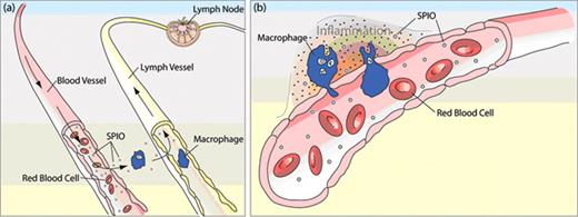 Figure 2. Schematic illustrating the transmigration of ultrasmall superparamagnetic iron oxide (USPIO) into the lymphatics and the uptake of USPIO by macrophages at a site of inflammation. (a) Intravenously injected USPIO are able to gain access to the interstitium and the lymphatic vessels as a consequence of their small size and long circulation times. This allows for imaging of the nodal architecture and detection of disturbances in nodal flow as a result of metastases. (b) At sites of inflammation, SPIO accumulate within the interstitium, due to an increase in the porosity of the endothelial wall, and are engulfed by macrophages.