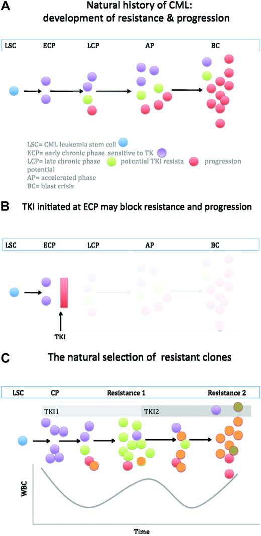 Figure 2. A highly simplified model of the natural history of CML. (a) The CML leukemia stem cell (blue) regenerates, but also gives rise to leukemia progenitors. Presumably early in the disease, most are sensitive to TKI. With time and unopposed Bcr-Abl activity, cells arise with mutations and/or genetic features of progression. The latter eventually have a greater proliferative edge, and progression to blast crisis occurs. (b) If a TKI is initiated early in disease, before genetic instability creates clones more prone to resistance and progression, the natural history may be aborted. This may be a partial explanation of why some patients in complete molecular remission may be removed from TKI therapy. (c) Once resistance allows unopposed Bcr-Abl signaling, more resistant clones can emerge. Thus, the likelihood of eventual resistance to the second TKI is high, as is the probability of new mutations emerging. Figure not to scale.