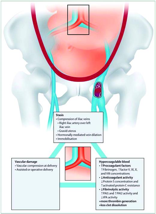 Figure 1. Virchow's triad in pregnancy. (From Bourjeily G, Paidas M, Khalil H, Rosene-Montella K, Rodger M. Pulmonary embolism in pregnancy. Lancet. 2010;375(9713):500–512. Used with permission.)
