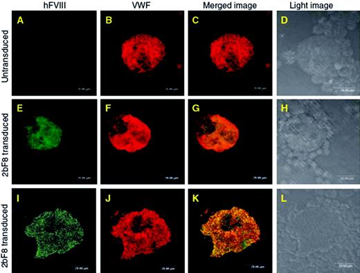 Figure 1. Induced FVIII expression in megakaryocytes under the control of the α-IIb promoter. Murine FVIII–/– bone marrow-derived hematopoietic stem cells were transduced with a lentiviral B domain-deleted cDNA construct for human FVIII (hFVIII) placed under the control of the integrin α-IIb promoter (2bF8) and the cells cultured in the presence of interleukin-3, interleukin-6, stem cell factor, thrombopoietin, and flt-3 ligand. Cells were immunostained for VWF (red) and FVIII (green). Untransduced cells only demonstrated VWF staining (A-D), whereas the 2bF8-transduced cells demonstrated FVIII immunostaining and colocalization of the FVIII with VWF (E-H and I-L). (Used with permission, with full details provided in J Thromb Haemostas. 2006;5:352-361.)