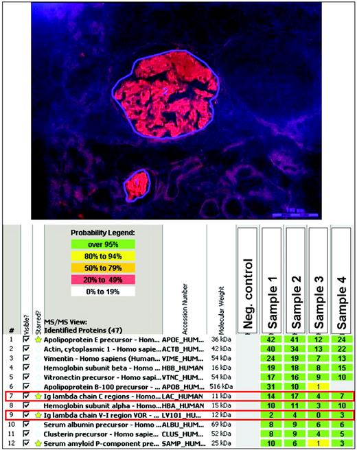 Figure 1. MS-based proteomic classification of amyloidosis. Amyloid deposits were identified on Congo-red-stained paraffin sections under fluorescent light and microdissected with a laser. The microdissected amyloid fragments were then digested into tryptic peptides, separated by nano-flow liquid chromatography, ionized by electrospray ionization, and analyzed by tandem MS/MS. MS raw data files were queried by the use of three different algorithms (Mascot, Sequest, and X!Tandem), and the results were assigned peptide and protein probability scores. The proteins are listed according to the abundance with which they were represented in the sample based on spectral counting. The amyloid-forming protein identified is immunoglobulin lambda light chain (red boxes; Ig lambda chain constant and V-I regions), which is consistent with AL (lambda-type) amyloidosis. In addition, the samples contain several proteins known to be associated with amyloid deposits, such as apolipoprotein E and the serum amyloid P component, as well as stromal proteins such as actin, vitronectin, and vimentin. The identity and amounts of chaperone and fellow-traveler proteins cannot be precisely determined by any other technique and, once data are available on a large number of annotated cases, correlative analyses will likely reveal patterns of disease and progression linked to aspects of these accompanying proteins, such as proportions and polymorphisms. (Images courtesy of Dr. Ahmet Dogan, Mayo Clinic, Rochester, MN; dogan.ahmet@mayo.edu. See Vrana et al., 20094 for more information.)