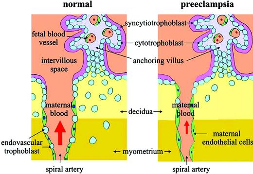 Figure 2. Abnormal placentation in preeclampsia. Note the decreased trophoblastic invasion at decidual and myometrial levels, narrower vascular lumen of the maternal uterine spiral artery, and failure of trophoblast cells to replace the maternal endothelium lining of the spiral artery in the preeclamptic placenta. Reproduced from Kita and Mitsushita,20 with permission.