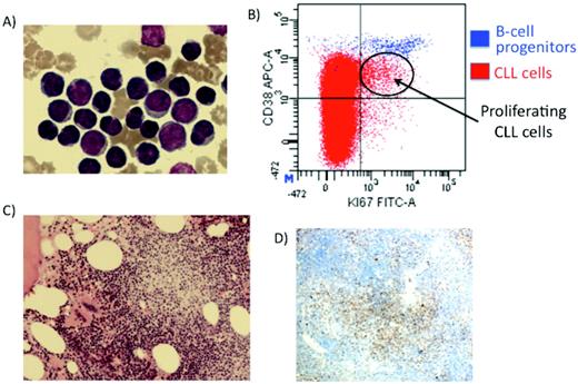Figure 1. Proliferating cells in CLL. (A) Mature peripheral blood cells with occasional larger cells. (B) Flow cytometry identifying the proliferative compartment in CLL (Ki-67 and CD38 + cells). (C) BM trephine-containing proliferation centers. (D) Ki-67 staining demonstrating CLL cells proliferating in the proliferation centers.