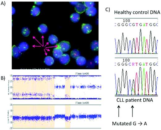 Figure 2. Analysis of the p53 pathway in CLL. (A) FISH with a green fluorescent chromosome 17 centromeric probe and a red 17p probe demonstrating the deletion of 17p in most, but not all, CLL cells. (B) Single-nucleotide polymorphism microarrays in CLL. The patient has loss of heterozygosity in part of the genome covered by the p53, suggesting that the CLL clone may have no active p53. The orange shaded area in the figure indicates a deletion of 17p. Direct sequencing is then possible. (C) Direct sequencing allows the identification of single p53 mutations. These mutations are often found when the other allele is deleted, although this is not the case here.