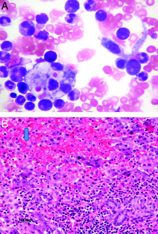 Figure 1. Evidence of HLH in children presenting with liver failure of unknown etiology. (A) BM aspirate showing hemophagocytosis in a patient admitted with acute liver failure. (B) Pathology from the explanted liver showing extensive necrosis and infiltration with histiocytes (arrow).