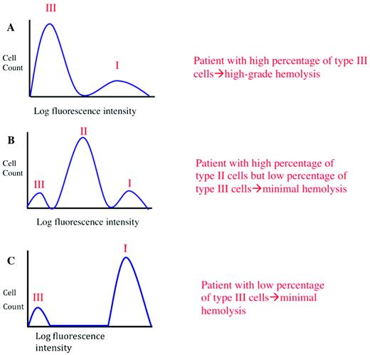 Figure 2. Clinical manifestations of PNH are determined by clone size and erythrocyte phenotype. Mock flow cytometry histograms of erythrocytes from hypothetical patients with PNH stained with anti-CD59 are illustrated. The proportion and type of abnormal erythrocytes varies greatly among patients with PNH, and these characteristics are important determinants of clinical manifestations. Patients with a high percentage of type III erythrocytes have clinically apparent hemolysis (A). If the erythrocytes are partially deficient (∼ 10% of normal expression) in GPI-AP (PNH II cells), hemolysis may be modest even if the percentage of the affected cells is high (B). A patient may have a diagnosis of PNH, but if the proportion of type III cells is low, only biochemical evidence of hemolysis may be observed (C).