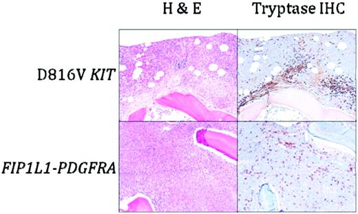 Figure 1. BM histopathology in D816V KIT-positive SM with eosinophilia (D816V KIT) and PDGFRA-positive myeloid neoplasia (FIP1L1-PDGFRA). Sections were stained with H&E or anti-tryptase antibody. Dense aggregates containing > 15 mast cells are seen in D816V KIT-positive SM with eosinophilia, whereas scattered spindle-shaped mast cells forming loose collections are typical of PDGFRA-positive myeloid neoplasia. Magnification is 100×.