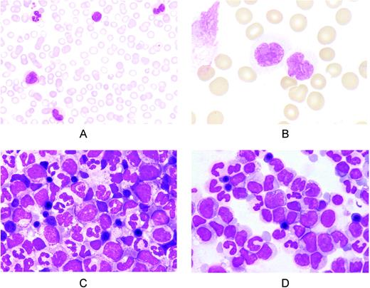 Figure 1. Representative peripheral blood and BM smears from patients with CMML. (A) Peripheral blood smear showing monocytosis with morphologically normal monocytes. May-Grünwald-Giemsa (MGG) staining; magnification, ×400. (B) Peripheral blood smear showing monocytes with nuclear and cytoplasmic abnormalities. MGG staining; magnification, ×1250. (C) BM smear showing high cellularity and hyperplasia of the granulocytic series with < 10% blasts (CMML-1). Erythroid cells are morphologically normal. MGG staining; magnification, ×1000. (D) BM smear from a patient with CMML-2 showing hyperplasia of monocytes and their precursors. The sum of blasts plus the promonocytes is 18%. MGG staining; magnification, ×1000.