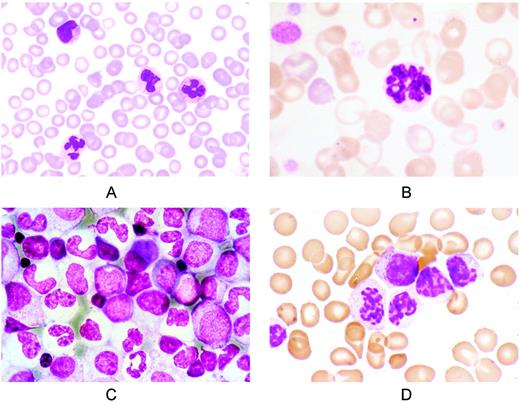 Figure 2. Representative peripheral blood and BM smears from patients with aCML, BCR-ABL 1 negative. (A) Peripheral blood smear showing leukocytosis. On the upper left is a metamyelocyte; lower left, a dysplastic neutrophil. May-Grünwald-Giemsa (MGG) staining; magnification, × 400. (B) Peripheral blood smear. A neutrophil with nuclear hypersegmentation (center) and a red cell with a Howell-Jolly body (top); left, polychromatic red cells and giant platelets. MGG staining; magnification, × 1250. (C) BM smear showing granuloblastic hyperplasia and erythroid hypoplasia. Mature neutrophils are agranular and show abnormal nuclear segmentation. Note the micromegakaryocyte (center). MGG staining; magnification, × 640. (D) Syndrome of abnormal chromatin clumping. Peripheral blood smear showing leukocytosis, immature granulocytes, and neutrophils with abnormal condensation of the nuclear chromatin. MGG staining; magnification, × 1250.