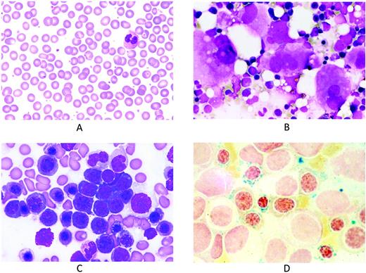 Figure 3. Representative peripheral blood and BM smears from patients with refractory anemia with ring sideroblasts and marked thrombocytosis. (A) Peripheral blood smear showing thrombocytosis. May-Grünwald-Giemsa (MGG) staining; magnification, × 1000. (B) BM smear showing numerous clustered megakaryocytes that are markedly enlarged and similar to those observed in essential thrombocythemia. MGG staining; magnification, × 500. (C) BM smear showing erythroid hyperplasia with macro-megaloblastoid changes. MGG staining; magnification, × 1000. (D) BM smear after Perls staining showing numerous ring sideroblasts. Magnification, × 1000.