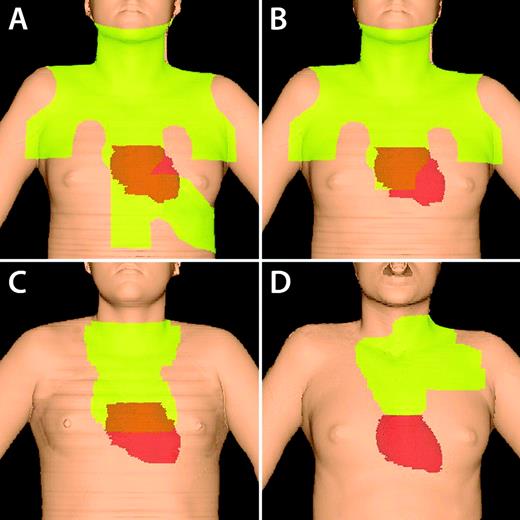 Figure 2. Changes in RT fields over time. Figures are 3-dimensional reconstructions of RT fields based on computed tomography imaging. Light green illustrates irradiated field. The true heart position is shown. (A) Mantle and upper abdomen (“spade”) field. Note the large volume of heart and left breast irradiated. (B) Mantle field. (C) IFRT for mediastinal disease without axillary disease. Less breast tissue is treated, although inclusion of the subcarinal nodes encompasses the proximal coronary arteries. (D) INRT for a patient with mediastinal, low neck, and high axillary disease. The patient was also treated with active breath hold to decrease heart dose.