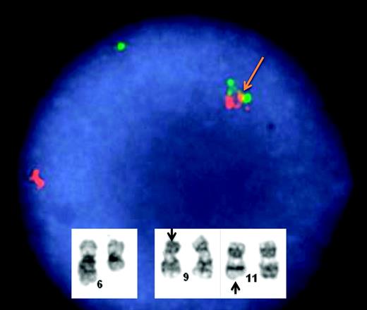 Figure 1. Karyotypic analysis in a 2-year-old boy who presented with M5a AML and relapsed 6 years later with the same translocation in precursor-B ALL. FISH for the MLL gene demonstrates a positive/rearranged result. This single-interphase nucleus shows the typical abnormal signal pattern for the MLL break-apart FISH probe. The abnormal MLL allele is identified by the distinctly separate (broken apart) orange and green signals (yellow arrow). In contrast, the remaining second MLL allele shows a normal fusion pattern of overlapping green and orange signals. Inset shows a selected G-banded karyotype demonstrating an abnormal karyotype; 46,XY,del(6)(q13),t(9;11)(p22;q23). The translocation involves a reciprocal exchange of genomic material on chromosomes 9 and 11. As a consequence of this translocation, the MLL gene localized to 11q23 is juxtaposed to the MLLT3 gene on 9p22, resulting in an oncogenic chimeric fusion gene. The translocation has been associated with IGSF4 overexpression that is partially regulated by promoter methylation.19 (Images courtesy of Dr. Kaaren Reichard.)