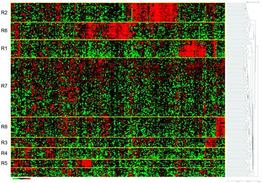 Figure 2. Heat-map analysis in 206 children and young adults with high-risk precursor B-ALL treated in COG study 9906. The R1 cohort captured all patients with MLL rearrangements and the R2 cohort captured all patients with the t(1;19). The R8 cohort was found to have BCR-ABL–like signature,32 CRLF2 mutations, and a poor outcome. Other mutations involving JAK were identified, suggesting that this cohort might respond to tyrosine kinase–directed therapy. The remaining R cohorts have molecular anomalies that remain undefined. (Used with permission from Harvey et al.33)