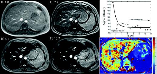 Figure 1. (Left) Open circles represent liver signal intensity and solid line reflects the R2* fit at different echo times (TE). (Right) A map generated by calculating R2* values for every voxel in the image, with the reported liver iron concentration (LIC) represent the average liver R2* value scaled by a linear equation.12