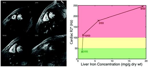 Figure 3. (Left) Cardiac T2* images depicting changes in heart and liver iron at four time-points over 3 years). (Right) Plot of heart R2* (iron) versus liver iron concentration using color coding corresponding to cardiac risk as in Figure 2.