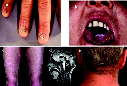 Figure 1. Clinical features of DC. The clinical features of DC are: nail dystrophy (A), oral leucoplakia (B), abnormal skin pigmentation (C), cerebellar hypoplasia (D; highlighted by the arrow), and premature hair loss/greying (E).