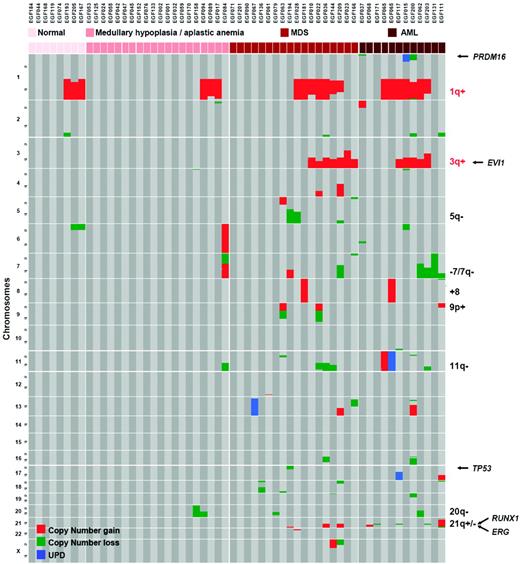 Figure 4. A recurrent profile of acquired chromosomal abnormalities in BM samples of FA patients. Samples are grouped by BM stages (normal, aplasia, MDS, and AML). The 1q+ and 3q+ lesions are specific from FA compared with MDS/AML of non-FA patients. Other abnormalities, including 7q− and RUNX1 mutations, can be found in non-FA patients. 1q+ is found at all stages of the BM progression, whereas most other lesions are found at the most advanced MDS/AML stages. (Used with permission from Quentin et al.30)