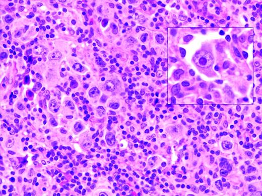 Figure 1. EBV-positive DLBCL of the elderly. Large lymphoid cells, some with prominent inclusion-like nucleoli (inset) are seen in a background of lymphocytes and histiocytes. Large lymphoid cells are EBV positive with EBER in situ hybridization (not shown).