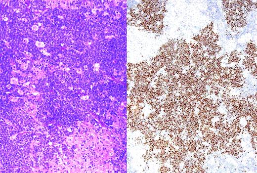 Figure 2. BL with immunohistochemistry for MYC protein. (Left) Section showing BL associated with an epithelioid granulomatous reaction. (Right) Same case stained for MYC protein; tumor cells show strong nuclear positivity, whereas epithelioid histiocytes are negative for MYC. Strong nuclear staining is typical of BL, but may be seen in some cases of DLBCL with a high proliferative rate.