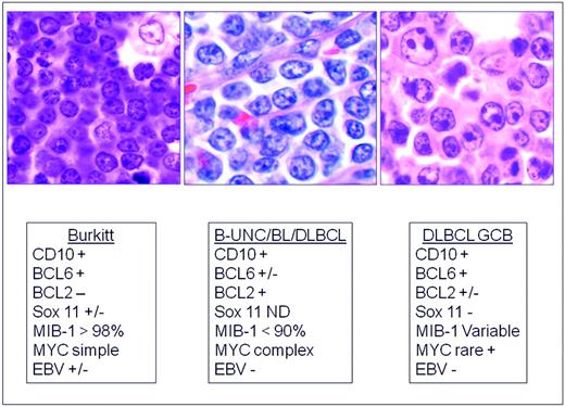 Figure 3. Differential diagnosis of BL, B-UNC/BL/DLBCL, and DLBCL of the GCB type. B-UNC/BL/DLBCL is generally associated with a complex karyotype containing both MYC and BCL2 translocations. BCL2 translocations are found in approximately 30% of the GCB type of DLBCL, but MYC translocation should be absent, and if a dual translocation is found, the case should be classified as B-UNC/BL/DLBCL. Morphologically, BL is composed of medium-sized cells, with minimal nuclear variation. Cell size is largest in DLBCL, and B-UNC/BL/DLBCL is generally composed of cells of intermediate to large size, with greater variability than BL.