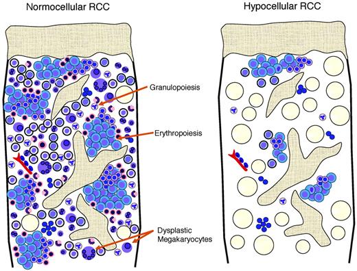 Figure 2. Schematic view of the histopathological pattern in RCC with normocellular and hypocellular BM.