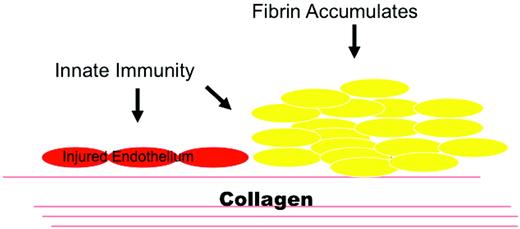 Figure 4. Innate immunity and hemostasis in aHUS. aHUS shows that regulatory proteins are vital for homeostasis. MCP and factor H protect cells from complement attack. Factor H can also transfer from plasma to cellular matrices such as an exposed basement membrane. Damage to an endothelial surface could result from a stressed, apoptotic, or necrotic cell that exposes the underlying basement membrane. The innate immune system responds to this injury state and facilitates wound repair. Excessive activation of the AP results in aHUS. (Used with permission from Tarr et al.20)