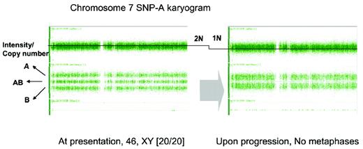 Figure 3. Detection of monosomy 7 in a patient with otherwise typical AA and failed cytogenetic examination due to lack of evaluable metaphases. SNP-A karyotyping was performed at 2 time points during the course of disease: at presentation (normal male karyogram) and at 12 months (noninformative cytogenetic examination). In general, the total copy number is around 2N (left). The second SNP-A karyotyping (right) demonstrates the deletion of one arm of chromosome 7, shown here as reduction of copy number (2N to 1N).