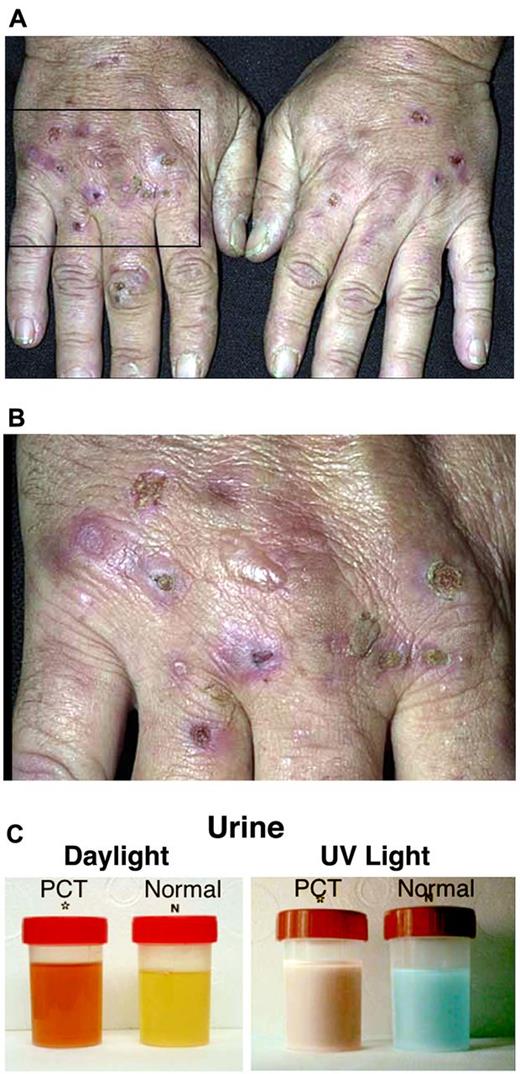 Figure 2. Porphyria cutanea tarda. (A-B) Sun-exposed hands of a PCT patient showing areas of atrophy and scarring. (C) Urine from a symptomatic PCT patient and a healthy control in daylight (left) and under ultraviolet light (right). The PCT urine has an orange-red color in daylight that fluoresces red under ultraviolet light.
