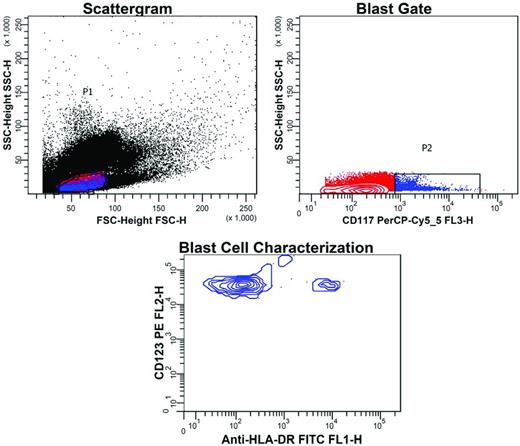 Figure 2. Flow cytometric detection of LSCs in a patient treated for AML. BM from a patient treated for AML was tested for MRD. Cells with the typical immunophenotype of LSCs had been demonstrated at this patient's presentation: CD34+CD123+CD117+HLA-DR−CD38−. After therapy, sequential gating for the presence of this phenotype was performed and detected 0.02% of these cells. In the scattergram, gate P1 was drawn around agranular cells (low side scatter, SSC) of small size (low forward scatter, FSC). In the blast gate, a second gate (P2) was drawn around cells with CD117 expression (blue dots), whereas the population of red cells in the first gate was CD117−. In the blast cell characterization contour plot, blast cells within the CD117+ cell population were demonstrated by expression of CD123, but negativity for HLA-DR. The small cell cluster with high HLA-DR expression represents some normal stem cells.