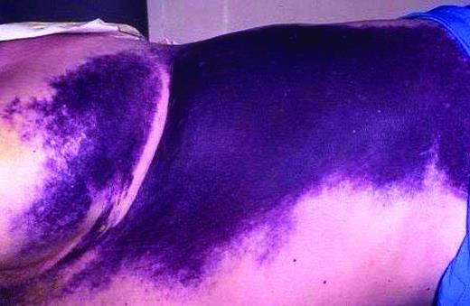 Figure 2. Superficial bleeding in AHA. Superficial bleeding is common in AHA and will often resolve without hemostatic therapy. The risk of thrombotic complications associated with bypassing agents needs to be weighed against the benefit of treatment, especially in patients with additional risk factors for thrombosis. In contrast, other types of bleeds need prompt treatment.