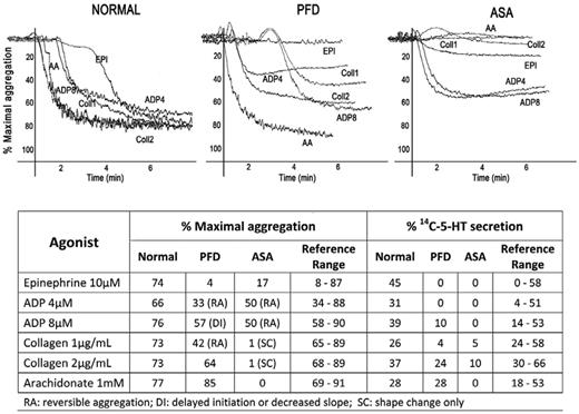 Figure 4. Typical platelet LTA tracings with different agonists in a healthy subject, a patient with a primary PFD, and a subject after aspirin (ASA) intake. The table shows the percentages of maximal aggregation to each agonist and the percentages of 14C-5-HT secretion of the same patients, respectively.