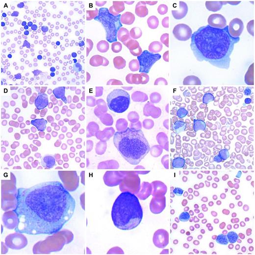 Figure 1. Acute leukemia and precursor neoplasms. (A) Precursor B-lymphoblastic leukemia with a very high WBC with numerous blasts and smudge cells. (B) Precursor B-lymphoblastic leukemia with 2 large lymphoblasts. (C) Precursor T-lymphoblastic leukemia with a lymphoblast containing a moderate amount of basophilic cytoplasm. (D) APL with t(15;17)(q22;q12); PML-RARA, the hypogranular variant with butterfly-shaped nuclei. (E) APL with an abnormal promyelocyte containing multiple Auer rods below a lymphocyte. (F) Transient abnormal myelopoiesis associated with Down syndrome in an infant with numerous large blasts, hypogranular platelets, nucleated RBCs, a megakaryocytic nuclear fragment, and scattered schistocytes. (G) Acute monoblastic leukemia with abundant lightly granular cytoplasm containing vacuoles. (H) Acute myeloid leukemia with t(8;21)(q22;q22); RUNX1-RUNX1T1 with a small myeloblast containing a thin, delicate Auer rod. (I) Recurrent acute myeloid leukemia with associated microangiopathic hemolysis (schistocytes) and a hypogranular platelet. The 2 myeloblasts at bottom right contain partially condensed chromatin and sparsely granular cytoplasm, features sometimes found in blasts seen in myeloid neoplasms with myelodysplasia.