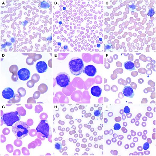 Figure 2. Lymphoid leukocytosis. (A) Infectious mononucleosis with a reactive lymphocytosis including an immunoblast at top. Note the pleomorphism of the lymphocytes. (B) A reactive lymphocytosis is seen in this patient with massive trauma due to a vehicular accident. (C) Large granular lymphocytosis, reactive. (D) CLL with characteristic small, round lymphocytes containing coarse, blocky chromatin. (E) Prolymphocytoid transformation in CLL. (F) Splenic marginal zone lymphoma with villous lymphocytes containing bipolar cytoplasmic projections. (G) Blastic MCL. (H) Lymphoplasmacytic lymphoma. (I) Circulating follicular lymphoma with clefted lymphoma cells.