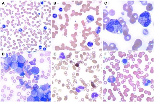Figure 3. Myeloid leukocytosis. (A) Neutrophilia in a patient with a perforated tumor and infection. (B) G-CSF effect with immature granulocytes. (C) Neutrophils with toxic granulation and vacuoles are seen in a patient with a bacterial infection. (D) CML, BCR-ABL1+, chronic phase, shows many immature granulocytes and occasional blasts. (E) CMML with abnormal monocytes and a large hypogranular platelet (adapted with permission from Pereira et al,7 page 101). (F) Myeloid neoplasm with eosinophilia and PDGFRA shows 2 eosinophils with eosinophilic granules that do not completely fill the cytoplasm and occasional hypogranular platelets.