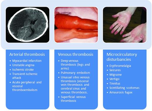 Figure 1. The spectrum of thrombotic manifestation in ET and PV. Thrombophilia, which severely affects the morbidity and mortality of PV and ET, is variably characterized by microcirculatory disturbances and arterial and venous thromboses that often precede disease recognition. Thrombotic occlusions of large arteries most commonly involve cerebral or coronary vessels. Ischemic stroke constitutes 30%-40% of all thrombotic events in PV patients. Acute coronary syndromes are more rare, particularly during followup of treated patients. Acute vascular occlusions in other areas are not uncommon both in PV and ET patients. Venous thrombosis usually manifests with an increased incidence of deep venous thromboses of the lower limbs, which may cause pulmonary embolism. Superficial phlebitis of the legs is also common and venous thromboses at unusual sites are not as rare as in the general population. Thromboses of cerebral sinuses and of splanchnic (portal and hepatic) veins have been repeatedly reported in relatively young female patients. Microcirculatory disturbances are the most peculiar thrombotic manifestations in PV and ET patients and are responsible for a wide range of clinical symptoms arising from the formation of platelet thrombi in the end-arterial circulation of the peripheral, cerebral, coronary, skin, and abdominal vessels.