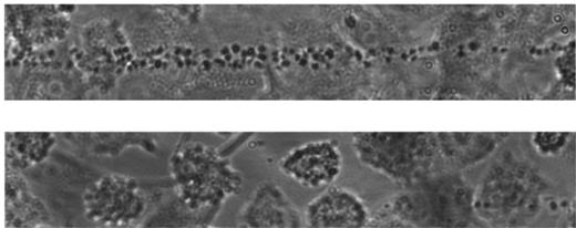 Figure 1. Pathogenesis of TTP. Shown are endothelial cell cultures stimulated to release VWF multimers perfused with fluorescence-labeled platelets suspended in a plasma with a severe ADAMTS13 deficiency of < 5% of the normal (top panel) or in a plasma with normal ADAMTS13 activity (bottom panel). Experiments were performed by Dr R. Fröhlich-Zahnd in the laboratory of Prof J.-F. Dong (at the time with the Department of Medicine, Baylor College of Medicine, Houston, TX, and now at the Puget Sound Blood Center, Seattle, WA).47,48