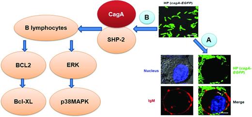 Figure 1. The H pylori protein CagA might function as a bacterium-derived oncoprotein in the carcinogenesis of gastric MALT lymphoma. (A) Translocation of CagA (EGFP) into BJAB (Epstein-Barr virus-negative Burkitt lymphoma) cells is revealed by immunohistochemical staining of cell surface IgM (red) and confocal microscopy. (B) H pylori–derived CagA can be translocated into B lymphocytes. Intracellular CagA coimmunoprecipitates with SHP-2, suggesting the involvement of CagA in the regulation of intracellular signaling pathways. Modified with permission from Lin et al.49