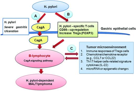Figure 2. Involvement of CagA-derived signals, T-cell–derived signals, and tumor microenvironment-related mediators in H pylori–induced lymphomagenesis of gastric MALT lymphoma. H pylori infection stimulates T lymphocytes in the gastric mucosa and indirectly induces the formation of MALT, from which B lymphocytes migrate and infiltrate the site of H pylori infection in the stomach. (A) The CagA protein may be translocated into B lymphocytes as it is secreted by H pylori on gastric epithelial surfaces, thereby resulting in a cascade of survival signaling in the B lymphocytes. (B) H pylori infection can also indirectly promote lymphomagenesis through T-cell–stimulatory pathways such as CD40-mediated signaling and the expression of Th-2–type cytokines and costimulatory molecules such as CD86. H pylori infection can stimulate CD4+CD25+ Tregs expressing FOXP3. (C) Molecular cross-talk between lymphoma B cells and factors in the tumor microenvironment (T cells and Th17 helper cell-regulated cytokines including IL-22, chemokines, and chemokine receptors) stimulate lymphoma cell survival.