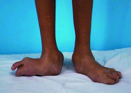 Figure 1. Arthrogryposis (persistent joint contractures), renal dysfunction, and cholestasis (ARC) syndrome is a very rare multisystem disorder. The degeneration of the anterior motor neuron cells causes multiple joint contractures, muscle weakness, and fibrosis. Decreased alpha granule proteins in ARC syndrome leads to platelet aggregation defects and bleeding tendency.