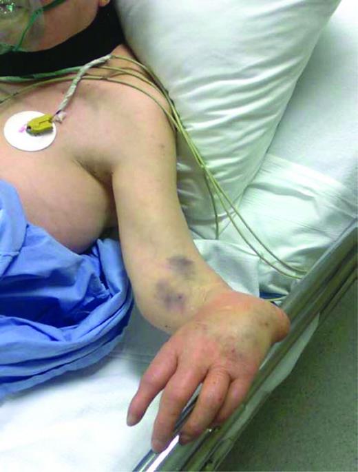 Figure 2. Thrombocytopenia-absent radii syndrome. The bilateral absence of radii in the forearm cause radial deviation of the hands. Reduced platelet count leads to bleeding diathesis.